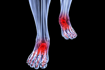 Arthritic foot and ankle care treatment in the Wayne County, MI: Detroit (Cornerstone Village, Conner Creek, Midtown, Grosse Pointe, Mexicantown, Harper Woods, Jefferson Chalmers, Springwells, Delray), West Detroit (Livonia, Westland, Redford Charter Twp, Inkster, Allen Park, Ecorse, Farmington, Southfield, Garden City), Northwest Detroit, Hamtramck (North End, Highland Park, Osborn, Islandview, Eastern Market, Corktown, Schulze, Eastpointe, Roseville), and Dearborn Heights (Canton, Romulus, Plymouth, Brightmoor), and Macomb County, MI: Sterling Heights (Madison Heights, Warren, Clawson, Center Line, Berkley, Royal Oak, Fitzgerald, Fraser, Birmingham, Lathrup Village) areas