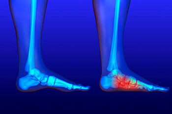 Flat feet and Fallen Arches treatment in the Wayne County, MI: Detroit (Cornerstone Village, Conner Creek, Midtown, Grosse Pointe, Mexicantown, Harper Woods, Jefferson Chalmers, Springwells, Delray), West Detroit (Livonia, Westland, Redford Charter Twp, Inkster, Allen Park, Ecorse, Farmington, Southfield, Garden City), Northwest Detroit, Hamtramck (North End, Highland Park, Osborn, Islandview, Eastern Market, Corktown, Schulze, Eastpointe, Roseville), and Dearborn Heights (Canton, Romulus, Plymouth, Brightmoor), and Macomb County, MI: Sterling Heights (Madison Heights, Warren, Clawson, Center Line, Berkley, Royal Oak, Fitzgerald, Fraser, Birmingham, Lathrup Village) areas