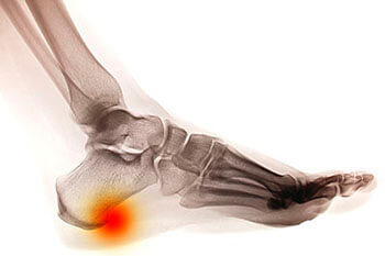 Heel spurs treatment in the Wayne County, MI: Detroit (Cornerstone Village, Conner Creek, Midtown, Grosse Pointe, Mexicantown, Harper Woods, Jefferson Chalmers, Springwells, Delray), West Detroit (Livonia, Westland, Redford Charter Twp, Inkster, Allen Park, Ecorse, Farmington, Southfield, Garden City), Northwest Detroit, Hamtramck (North End, Highland Park, Osborn, Islandview, Eastern Market, Corktown, Schulze, Eastpointe, Roseville), and Dearborn Heights (Canton, Romulus, Plymouth, Brightmoor), and Macomb County, MI: Sterling Heights (Madison Heights, Warren, Clawson, Center Line, Berkley, Royal Oak, Fitzgerald, Fraser, Birmingham, Lathrup Village) areas