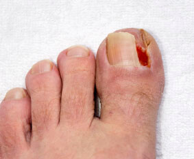 Ingrown toenails treatment in the Wayne County, MI: Detroit (Cornerstone Village, Conner Creek, Midtown, Grosse Pointe, Mexicantown, Harper Woods, Jefferson Chalmers, Springwells, Delray), West Detroit (Livonia, Westland, Redford Charter Twp, Inkster, Allen Park, Ecorse, Farmington, Southfield, Garden City), Northwest Detroit, Hamtramck (North End, Highland Park, Osborn, Islandview, Eastern Market, Corktown, Schulze, Eastpointe, Roseville), and Dearborn Heights (Canton, Romulus, Plymouth, Brightmoor), and Macomb County, MI: Sterling Heights (Madison Heights, Warren, Clawson, Center Line, Berkley, Royal Oak, Fitzgerald, Fraser, Birmingham, Lathrup Village) areas