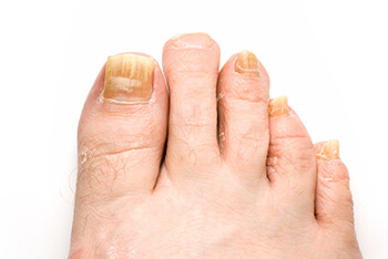 Fungal toenails treatment in the Wayne County, MI: Detroit (Cornerstone Village, Conner Creek, Midtown, Grosse Pointe, Mexicantown, Harper Woods, Jefferson Chalmers, Springwells, Delray), West Detroit (Livonia, Westland, Redford Charter Twp, Inkster, Allen Park, Ecorse, Farmington, Southfield, Garden City), Northwest Detroit, Hamtramck (North End, Highland Park, Osborn, Islandview, Eastern Market, Corktown, Schulze, Eastpointe, Roseville), and Dearborn Heights (Canton, Romulus, Plymouth, Brightmoor), and Macomb County, MI: Sterling Heights (Madison Heights, Warren, Clawson, Center Line, Berkley, Royal Oak, Fitzgerald, Fraser, Birmingham, Lathrup Village) areas