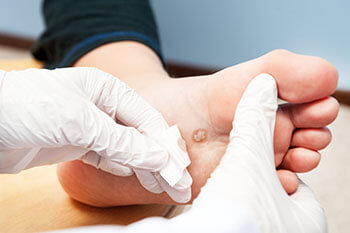 Plantar warts specialist in the Wayne County, MI: Detroit (Cornerstone Village, Conner Creek, Midtown, Grosse Pointe, Mexicantown, Harper Woods, Jefferson Chalmers, Springwells, Delray), West Detroit (Livonia, Westland, Redford Charter Twp, Inkster, Allen Park, Ecorse, Farmington, Southfield, Garden City), Northwest Detroit, Hamtramck (North End, Highland Park, Osborn, Islandview, Eastern Market, Corktown, Schulze, Eastpointe, Roseville), and Dearborn Heights (Canton, Romulus, Plymouth, Brightmoor), and Macomb County, MI: Sterling Heights (Madison Heights, Warren, Clawson, Center Line, Berkley, Royal Oak, Fitzgerald, Fraser, Birmingham, Lathrup Village) areas