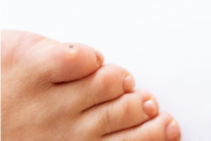 Difference Between Corns and Calluses