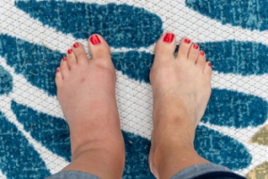 Uncommon Causes of Swollen Feet