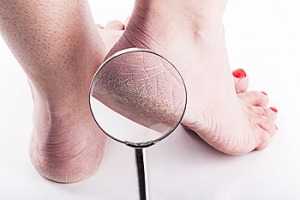 Treating Cracked Heels