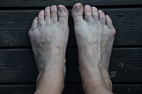 What Is a Tailor’s Bunion?
