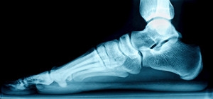 How to Determine If You Have Flat Feet