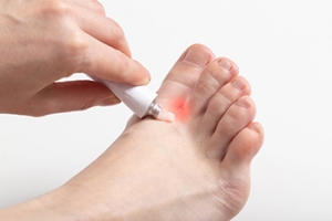 Signs of Athlete&#039;s Foot