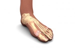 The Relationship Between Gout and Alcohol