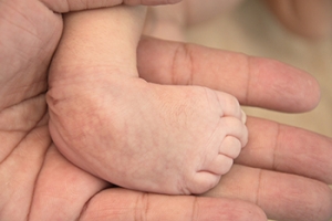Examples of Congenital Foot Conditions