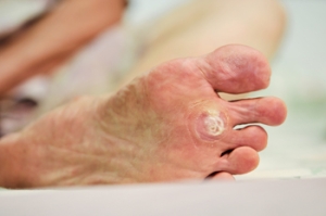 Symptoms and Treatment of Plantar Warts